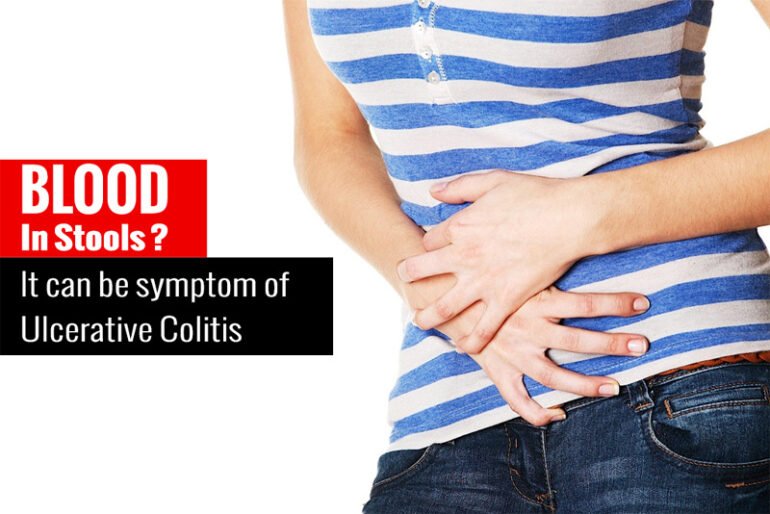 Blood in Stools? It can be Symptom of Ulcerative Colitis Dr Pathik Parikh