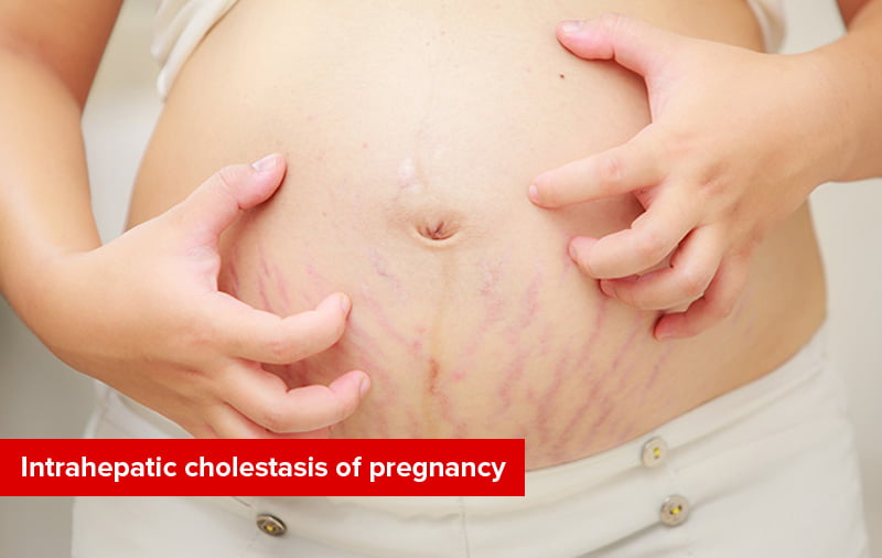 Intrahepatic Cholestasis Of Pregnancy