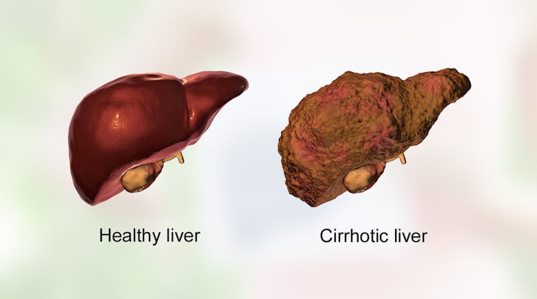 what is cirrhosis of the liver
