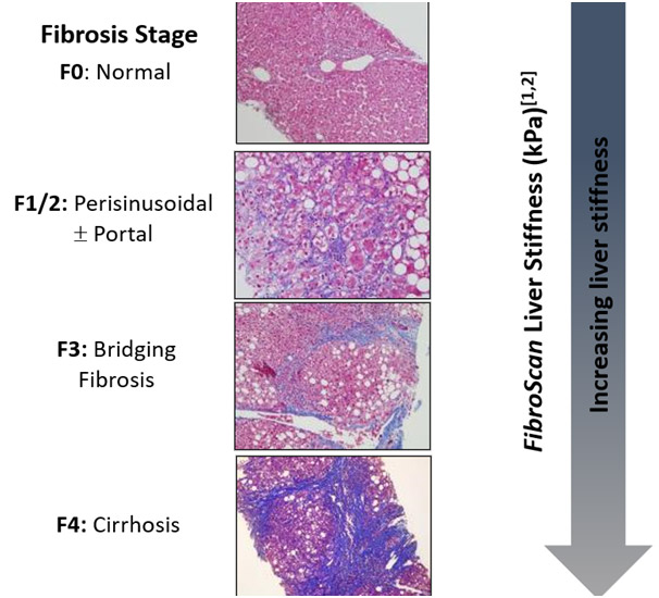 Fibrosis Stages