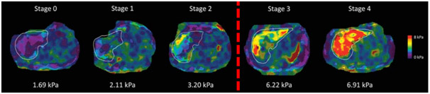 MR Elastography