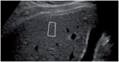 Point Shear Wave Elastography